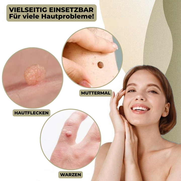 DermaLinx Wart Remover | Painless Removal of Warts and Moles | For Home Use | No Surgery