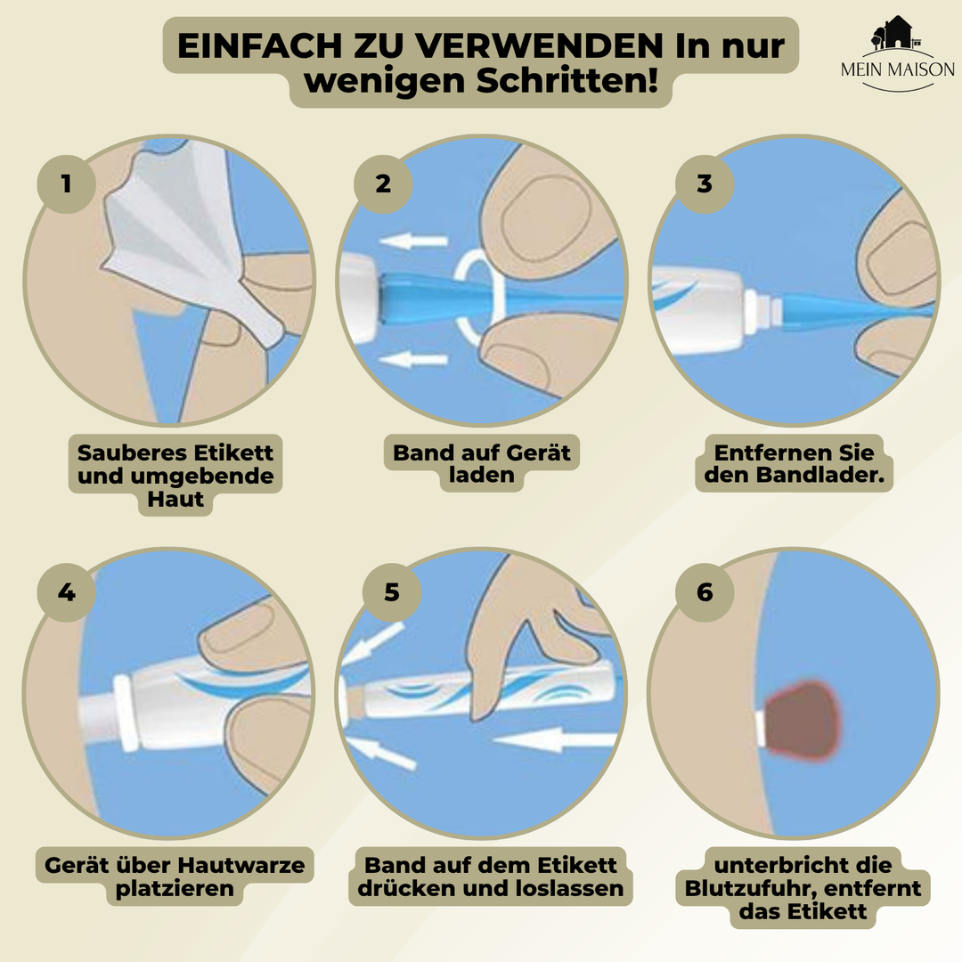 DermaLinx Wart Remover | Painless Removal of Warts and Moles | For Home Use | No Surgery