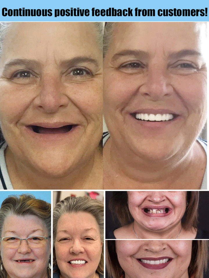 Flexible denture set for upper and lower jaw – reusable & customisable